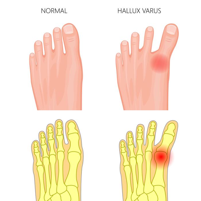 What are the Causes of Hallux Rigidus